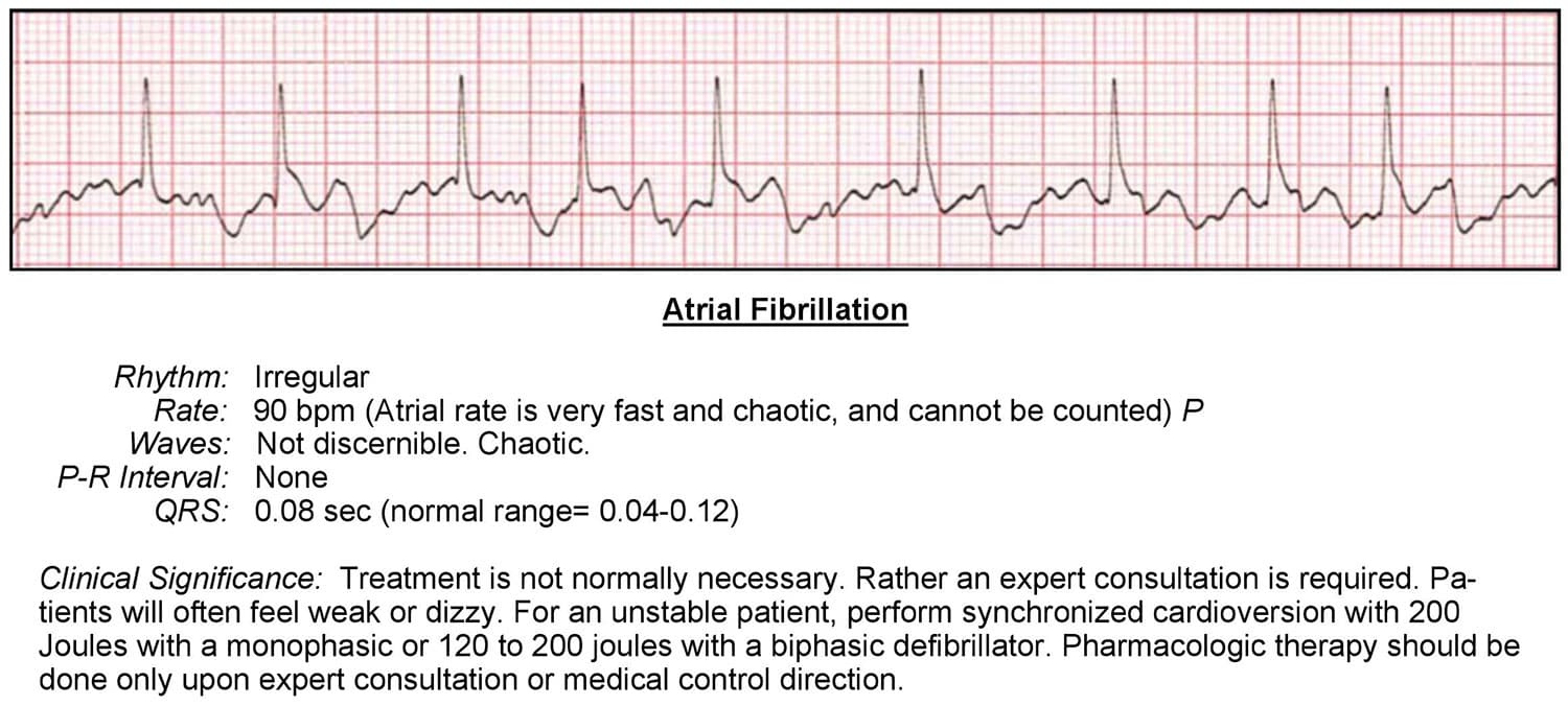 Atrial Fibrillation ECG ACLS Wiki