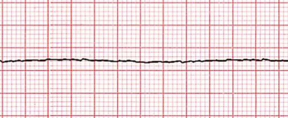 pulseless electrical activity vs asystole