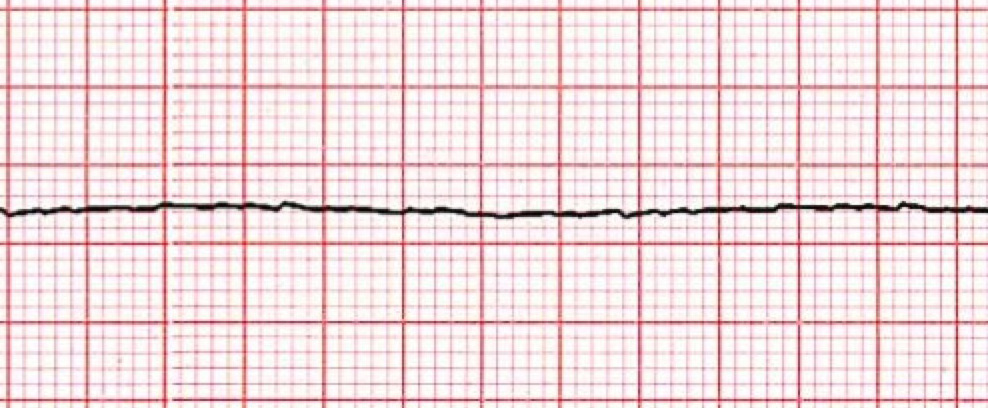 asystole-acls-wiki