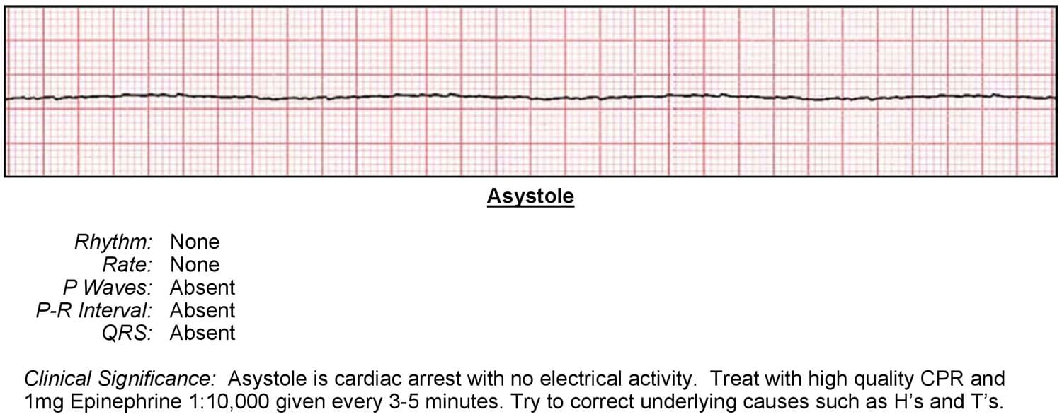 ventricular fibrillation pulseless electrical activity ecg