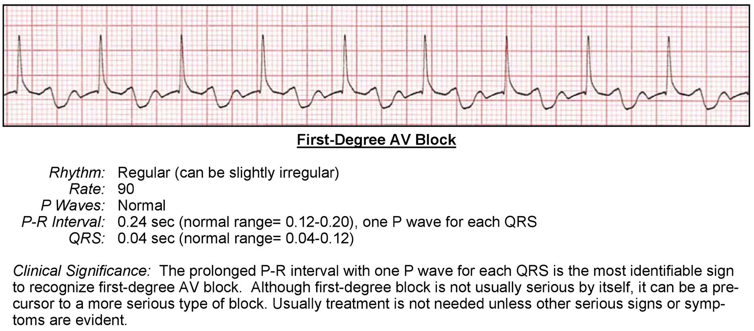 Atrioventricular Block Rhythm Ericvisser