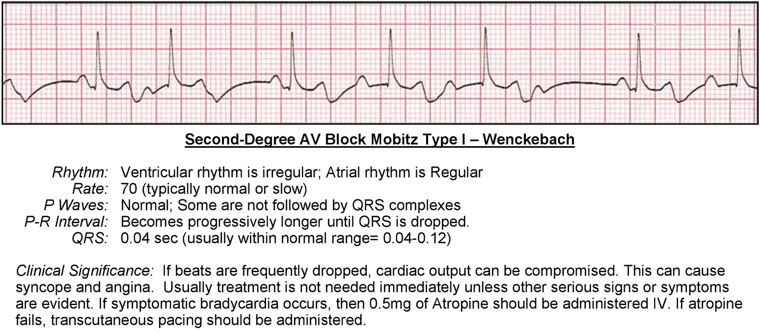 second-degree-av-block-mobitz-type-i-wenckebach-acls-wiki