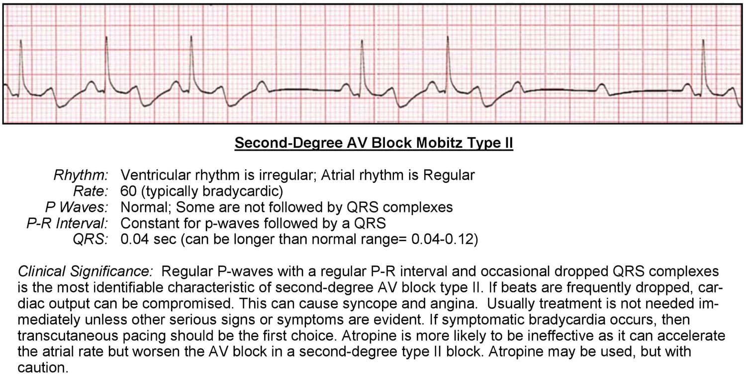 2nd Degree AV Block ECG