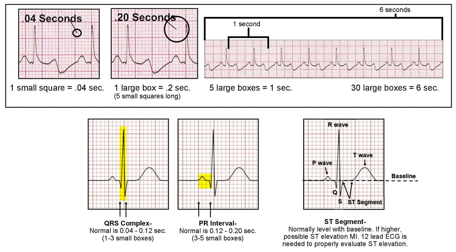 How to read and interpret an ECG/EKG - ACLS Wiki