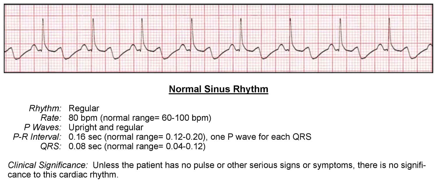 normal qrs time