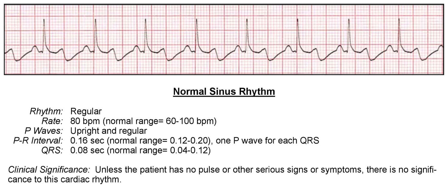 Normal Sinus Rhythm ACLS Wiki