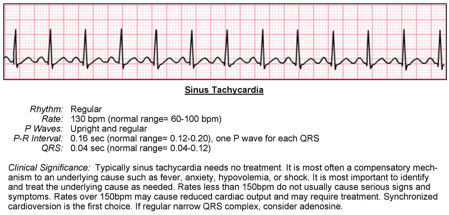 paroxysmal atrial tachycardia vs sinus tachycardia
