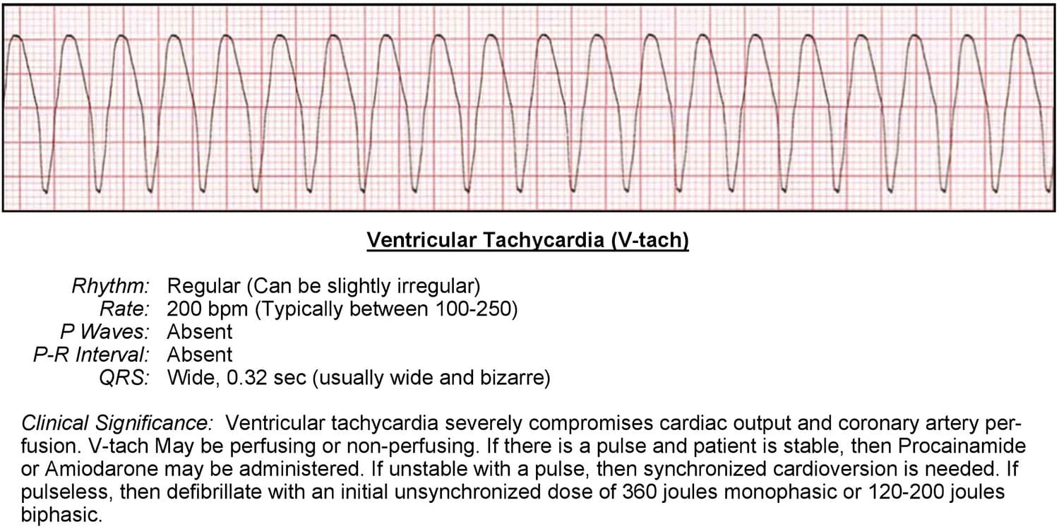 Wide Complex Ventricular Tachycardia - ACLS Wiki